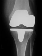 Röntgen nach Kniegelenksprothese