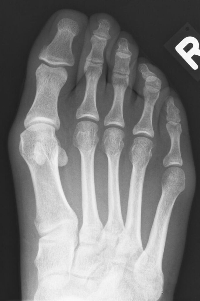 Röntgen Fußchirurgie