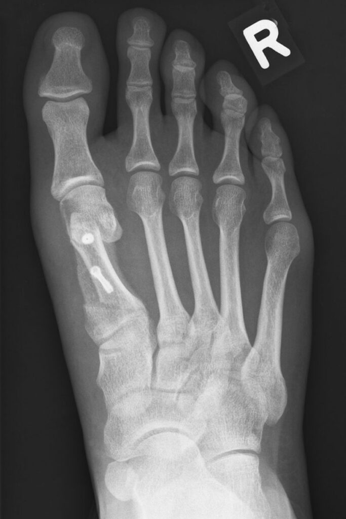 Fußchirurgie Röntgen nach Scarf