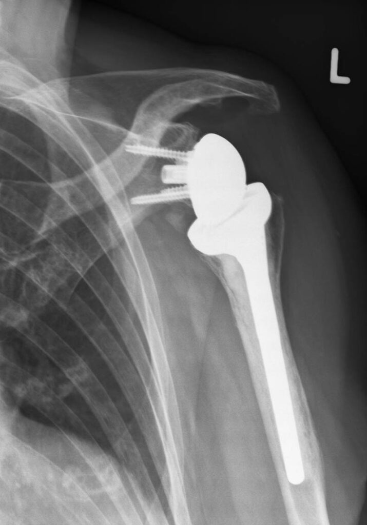 Röntgen Schulterchirurgie