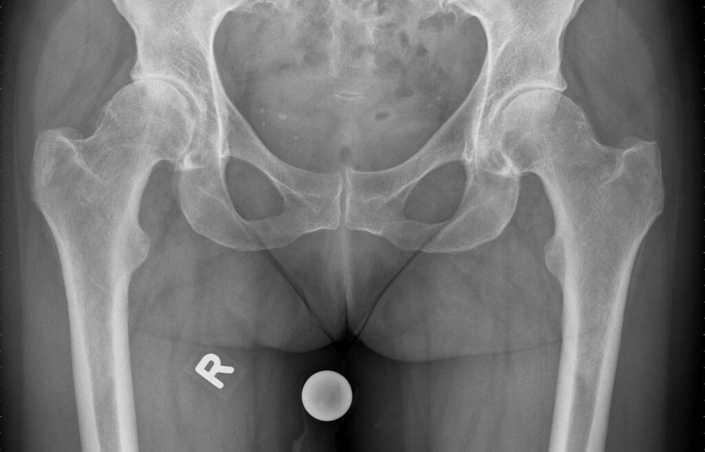 Röntgenbild vor Hüftgelenksprothese
